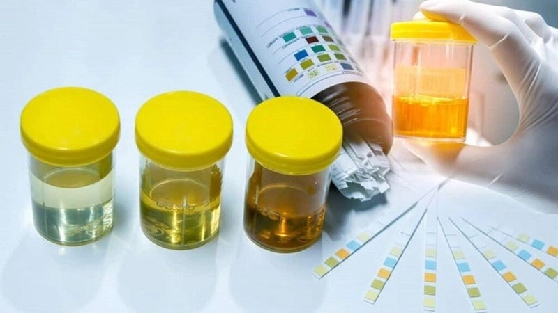 Bạch cầu trong nước tiểu bao nhiêu là bình thường? Lưu ý khi đo bạch cầu trong nước tiểu 3