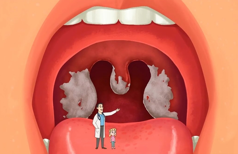 Bạch hầu thanh quản: Nguyên nhân, triệu chứng, chẩn đoán và điều trị 1