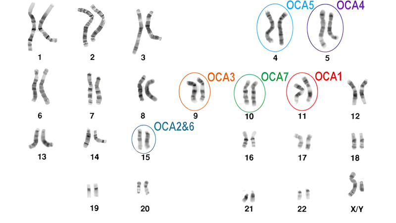 Bạch tạng: Nguyên nhân, triệu chứng và chế độ sinh hoạt 3