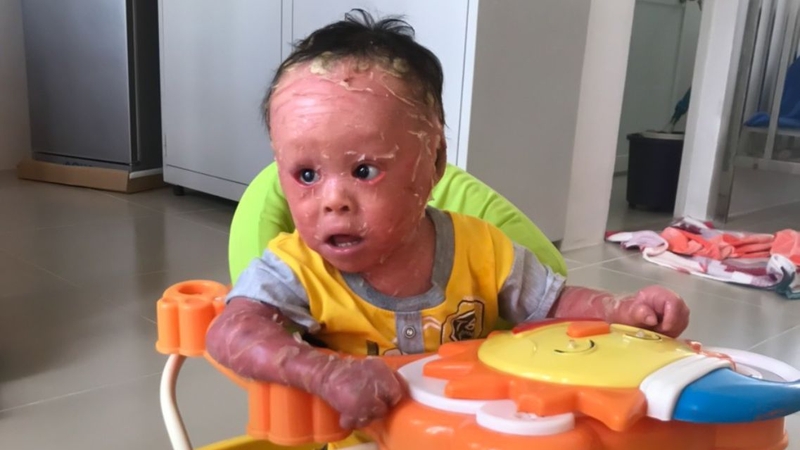 Bệnh vảy cá Harlequin: Nguyên nhân, biểu hiện, cách điều trị 2