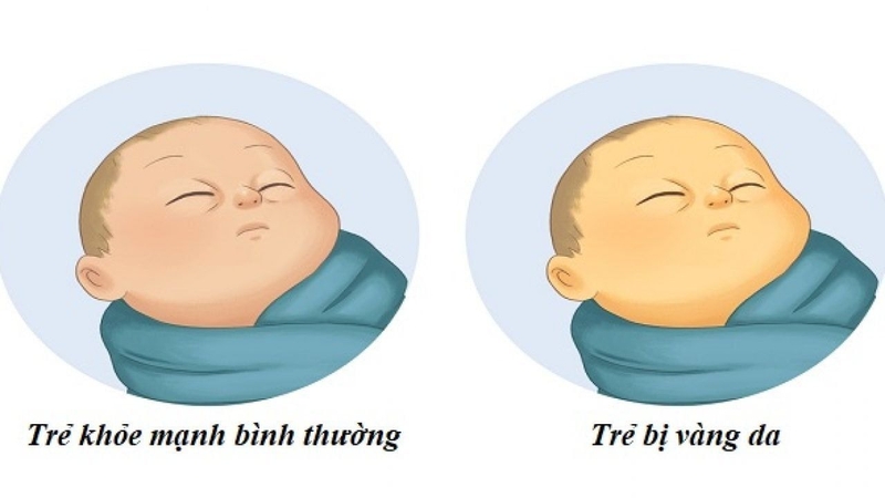 Bại não bẩm sinh: Triệu chứng, yếu tố nguy cơ và cách phòng ngừa 4