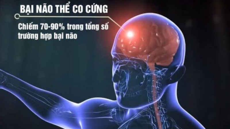 Bại não thể co cứng: Triệu chứng, chuẩn đoán và phương pháp điều trị 1