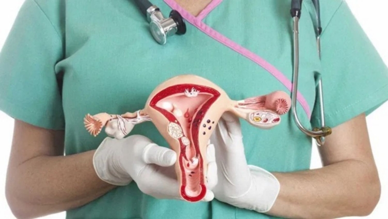 Bài tập phòng ngừa u xơ tử cung hiệu quả? Những điều cần lưu ý về u xơ tử cung 1