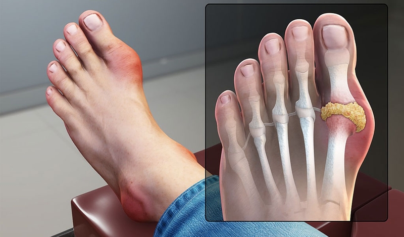 Bài thuốc Đông y chữa bệnh gout: Nhanh chóng và hiệu quả 1