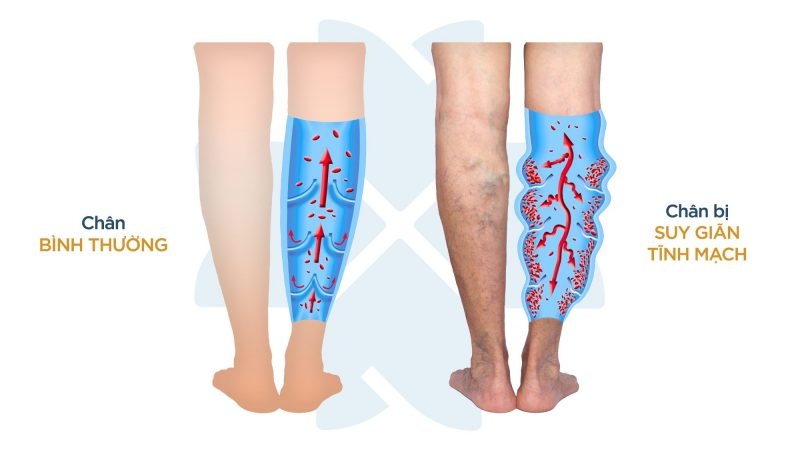 Bài thuốc đông y trị giãn tĩnh mạch chân1