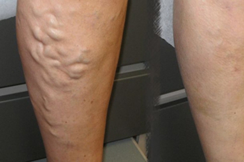 Bài thuốc đông y trị giãn tĩnh mạch chân2