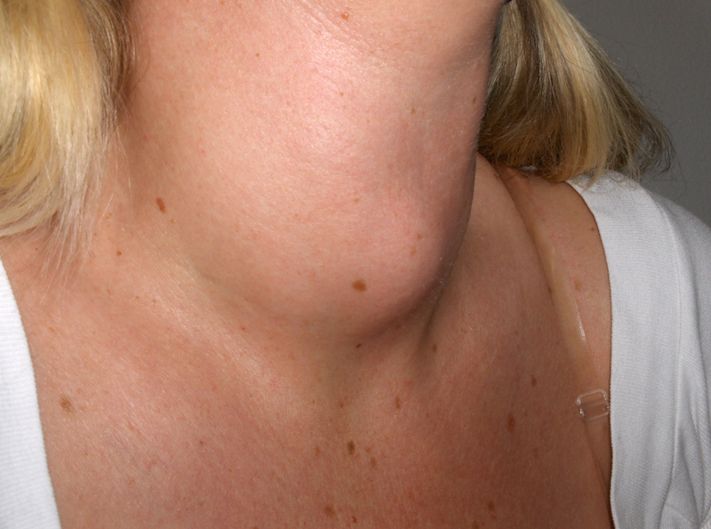 10 dấu hiệu bệnh tuyến giáp ở nữ phổ biến chị em cần biết 2