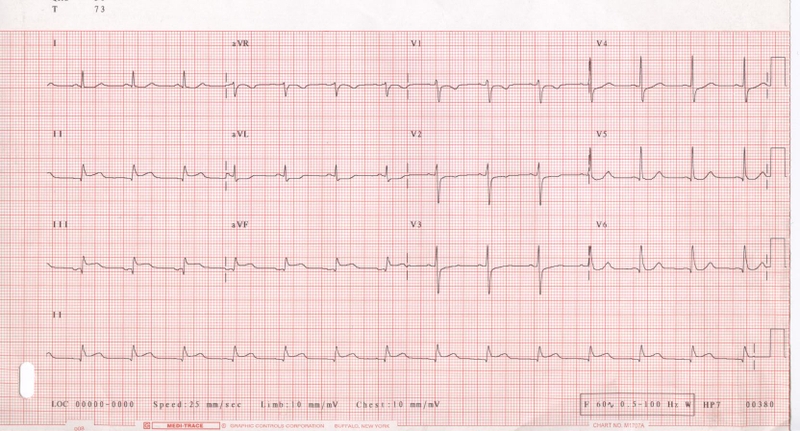 4 xét nghiệm chẩn đoán nhồi máu cơ tim cơ bản và phổ biến nhất hiện nay 2