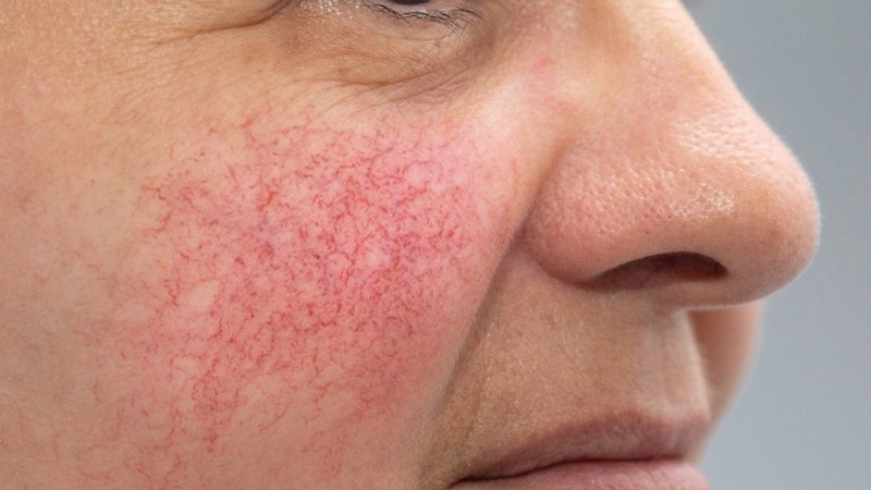 Da mặt đỏ và giãn mao mạch có thể là dấu hiệu sớm cần chú ý