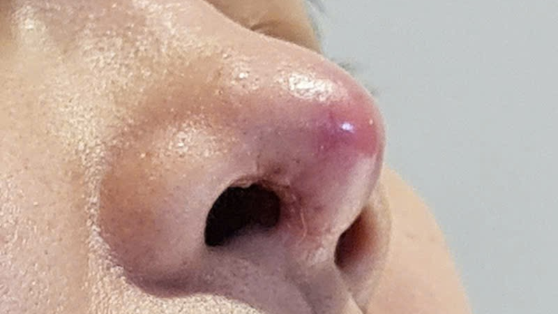Dấu hiệu sưng đỏ, đau nhức có thể là cảnh báo nhiễm trùng sau phẫu thuật