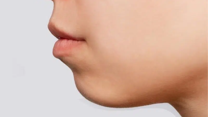 Cằm lẹm gây mất cân đối cho tổng thể khuôn mặt