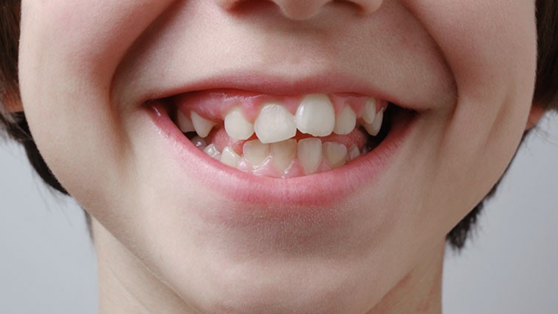 Các dạng sai lệch khớp cắn cần được can thiệp sớm