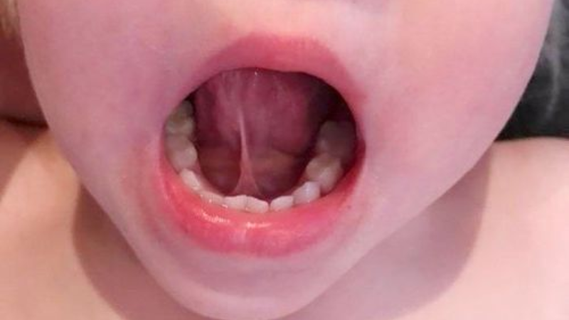 Cứng lưỡi là tình trạng lưỡi co cứng, giảm độ linh hoạt và gây khó khăn khi nói, nhai hoặc nuốt