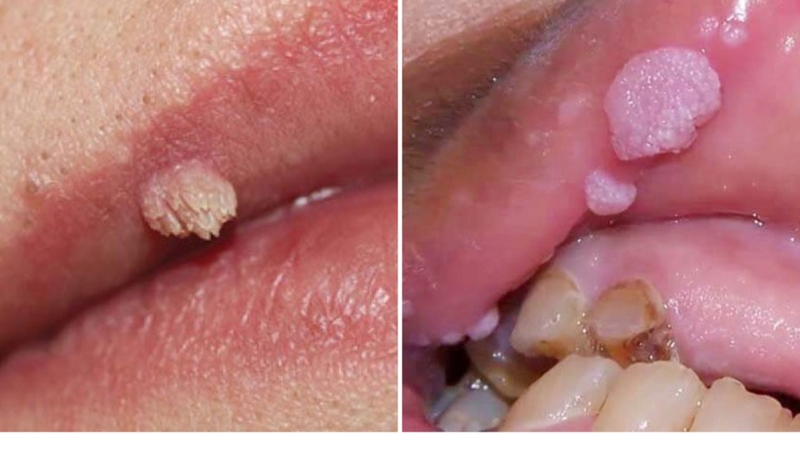 Dấu hiệu nhận biết và cách chữa trị hiệu quả sùi mào gà ở môi2