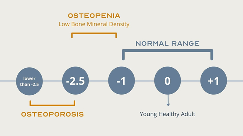 Kết quả DEXA dựa vào T-score để đánh giá mật độ xương và xác định nguy cơ loãng xương