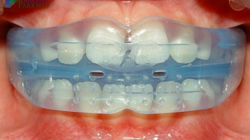 Hàm trainer là khí cụ chỉnh nha tháo lắp, giúp định hướng răng, hỗ trợ phát triển xương hàm ở trẻ