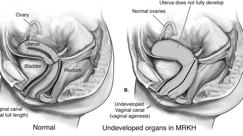 Hội chứng MRKH là dị tật bẩm sinh khiến tử cung và một phần âm đạo không phát triển