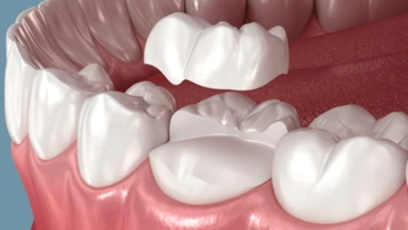 Onlay bao phủ một hoặc nhiều múi răng bị tổn thương
