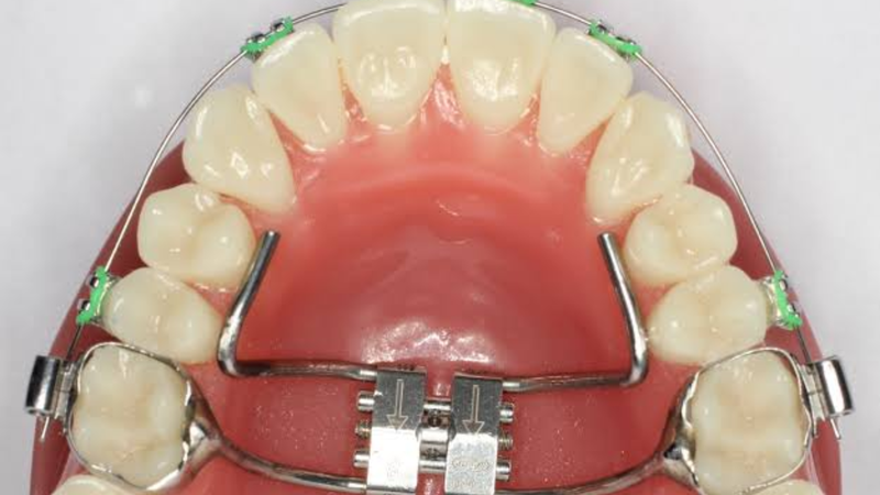 Khí cụ chỉnh nha giúp nắn chỉnh răng về đúng vị trí mong muốn