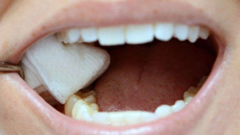 Cắn gạc đúng cách là bước đầu tiên và quan trọng nhất để cầm máu