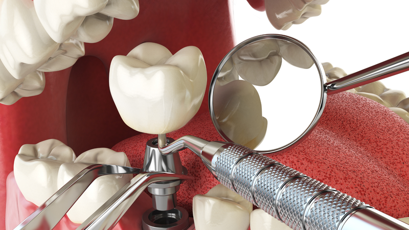 Cấy ghép Implant là giải pháp phục hồi răng mất tối ưu nhất hiện nay
