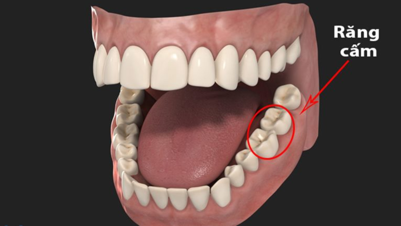 Vị trí và vai trò quan trọng của răng cấm trong cung hàm