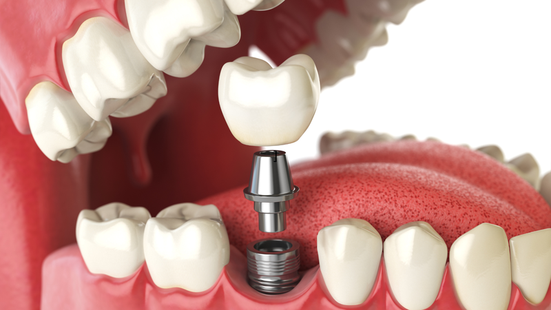 Trồng răng Implant là giải pháp tối ưu để phục hồi răng đã mất