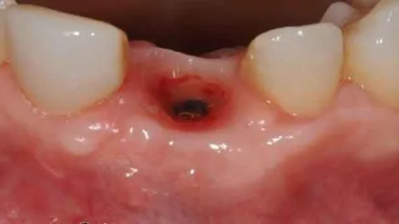 Viêm ổ răng khô làm lộ xương và dây thần kinh, gây đau đớn dữ dội