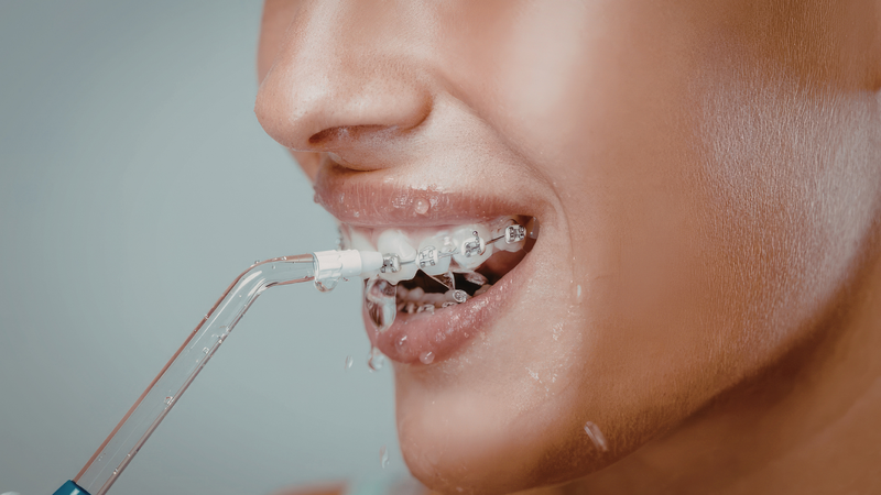 Vệ sinh răng miệng khi niềng răng đúng cách giúp ngăn ngừa sâu răng và viêm nướu