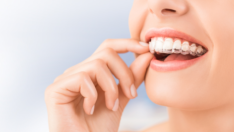 Mỗi khay niềng mới sẽ tạo ra lực di chuyển răng trong vài ngày đầu