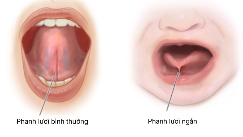 Cấu trúc của phanh lưỡi bình thường và phanh lưỡi ngắn