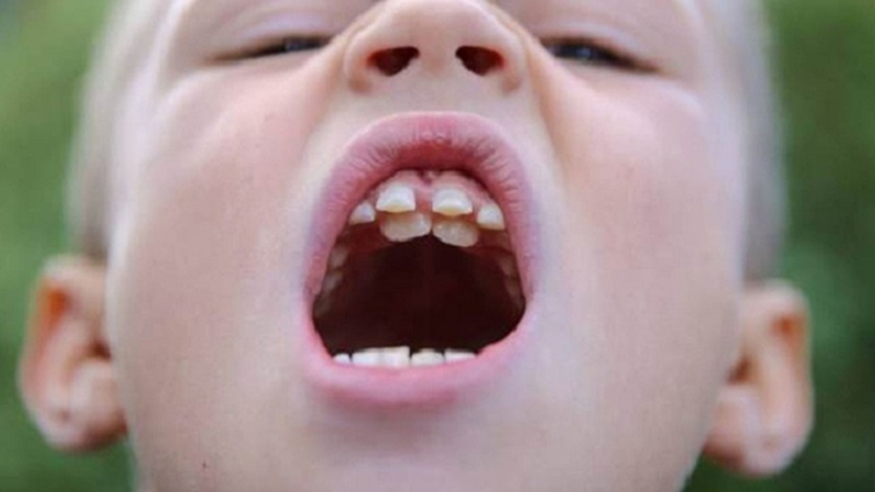 Răng mọc lẫy có thể gây khó vệ sinh, tăng nguy cơ sâu răng, viêm nướu và ảnh hưởng đến khớp cắn