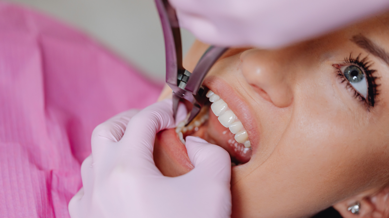 Nhổ răng số 8 mọc ngang cần thực hiện đúng quy trình và chăm sóc sau nhổ để nhanh hồi phục