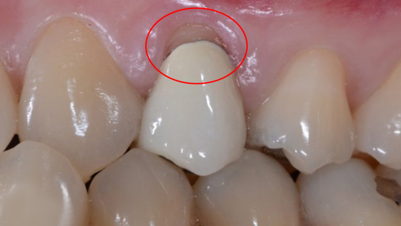 Răng sứ bị rớt ra khiến cùi răng bị lộ ra ngoài có thể gây ê buốt và khó chịu