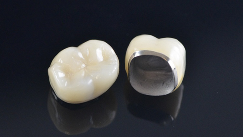 Răng sứ Titan và các phục hình kim loại có thể gây nhiễu ảnh (artifact) và rủi ro an toàn trong môi trường MRI