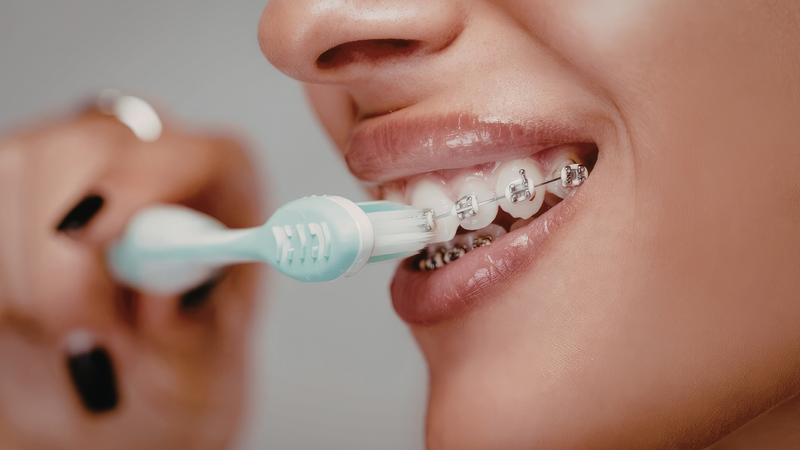 Chăm sóc răng miệng đúng cách sau khi siết răng giúp giảm đau và hạn chế khó chịu