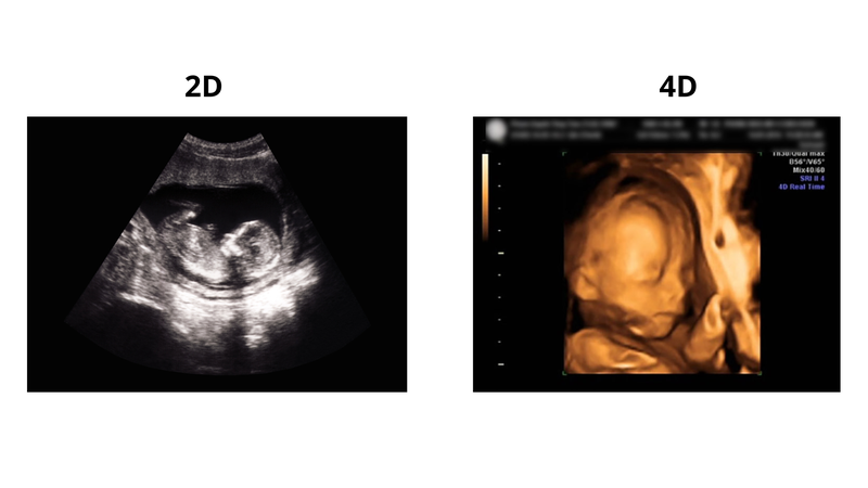 Siêu âm 2D và 4D có vai trò khác nhau trong việc quan sát và đánh giá thai nhi