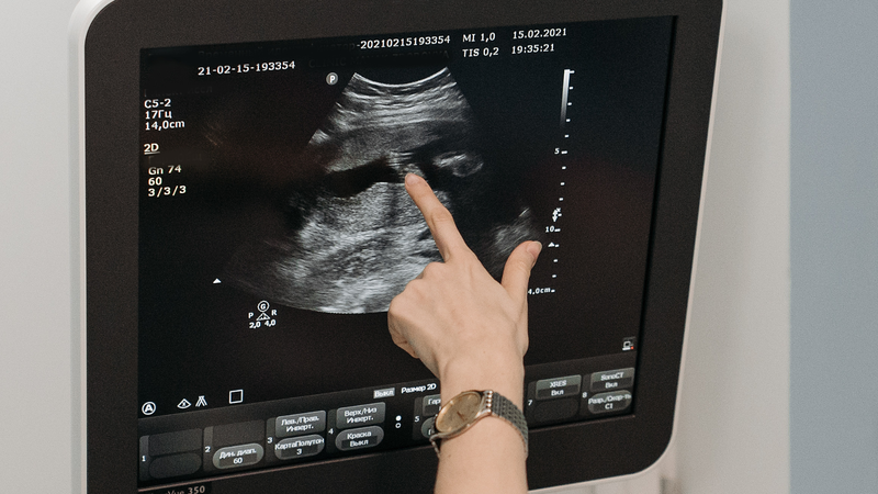 Bác sĩ đánh giá kết quả siêu âm tử cung buồng trứng để tư vấn hướng theo dõi và điều trị phù hợp