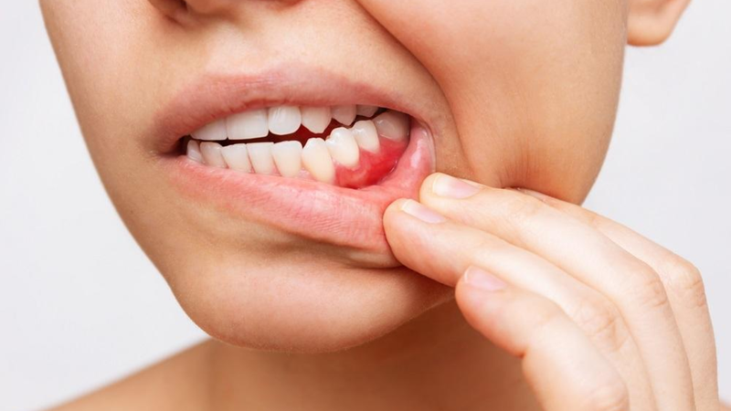 Sưng nướu sau nhổ răng thường giảm dần và gần hết sau khoảng 5–7 ngày