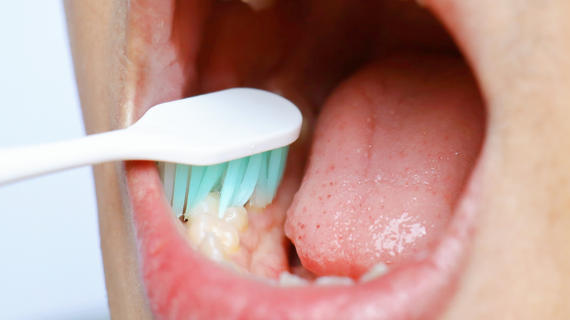 Sau khi trám răng, cần chải răng đúng cách để bảo vệ miếng trám