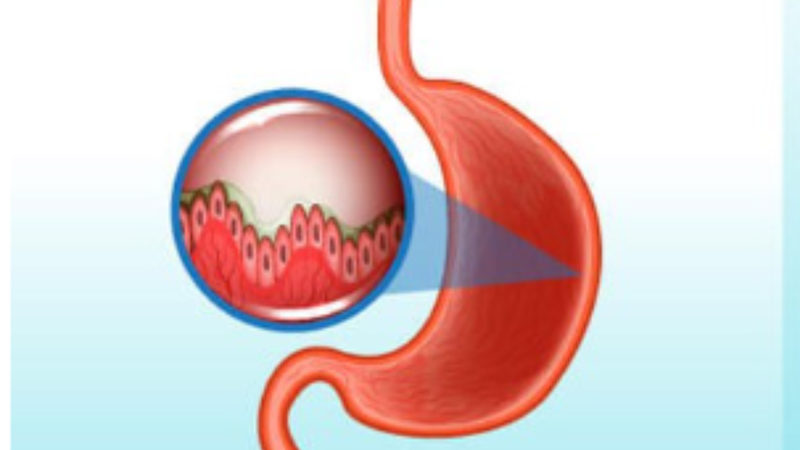 Nguyên nhân chính của viêm teo niêm mạc dạ dày là nhiễm vi khuẩn H. pylori và các bệnh tự miễn