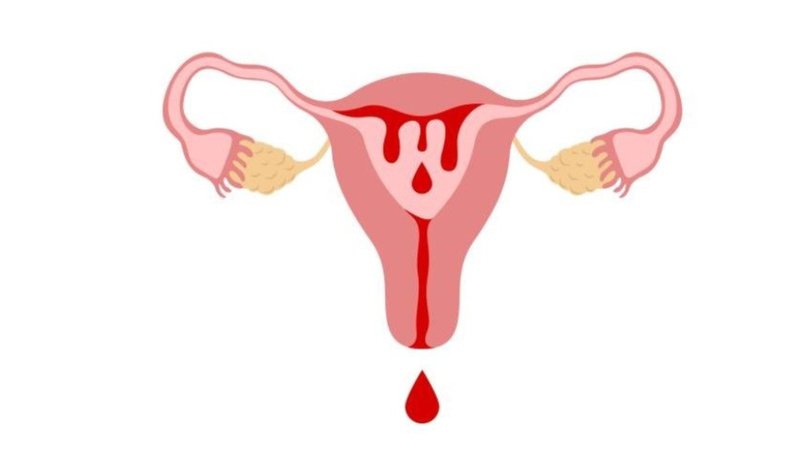 Chảy máu âm đạo bất thường là dấu hiệu cảnh báo cần đi khám ngay