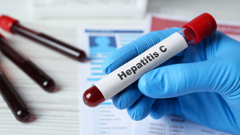 Viêm gan C được xem là mạn tính khi xét nghiệm HCV RNA vẫn dương tính sau 6 tháng