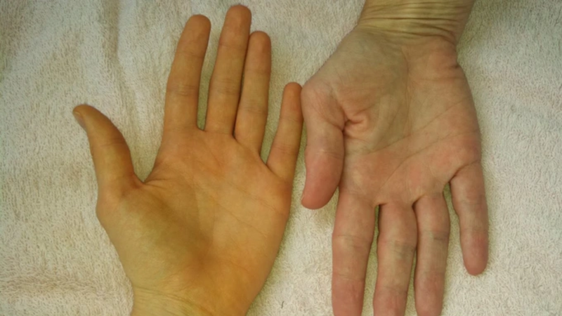 Vàng da là một dấu hiệu cảnh báo vấn đề về gan không thể bỏ qua