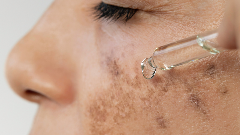 Đốm đen có thể cải thiện bằng kem bôi, laser hoặc peel da theo chỉ định bác sĩ
