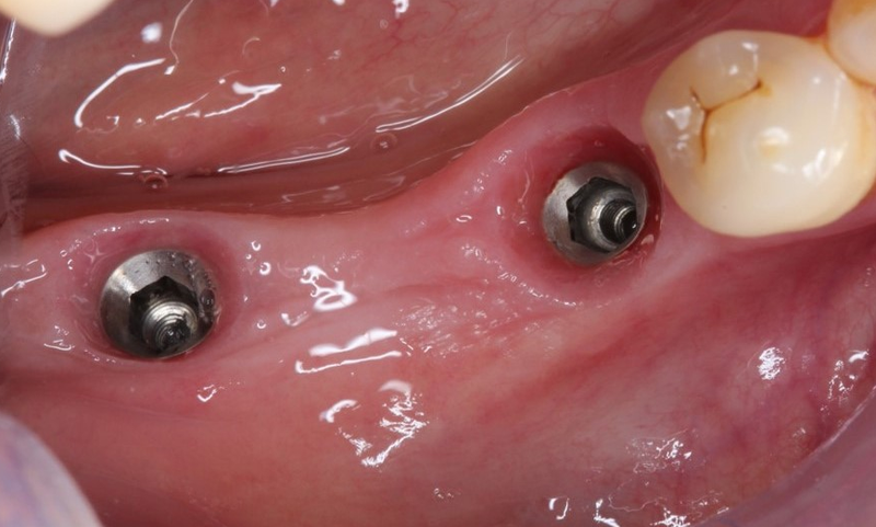 Abutment cá nhân hóa là gì? Chi phí và đối tượng nên cân nhắc sử dụng 1