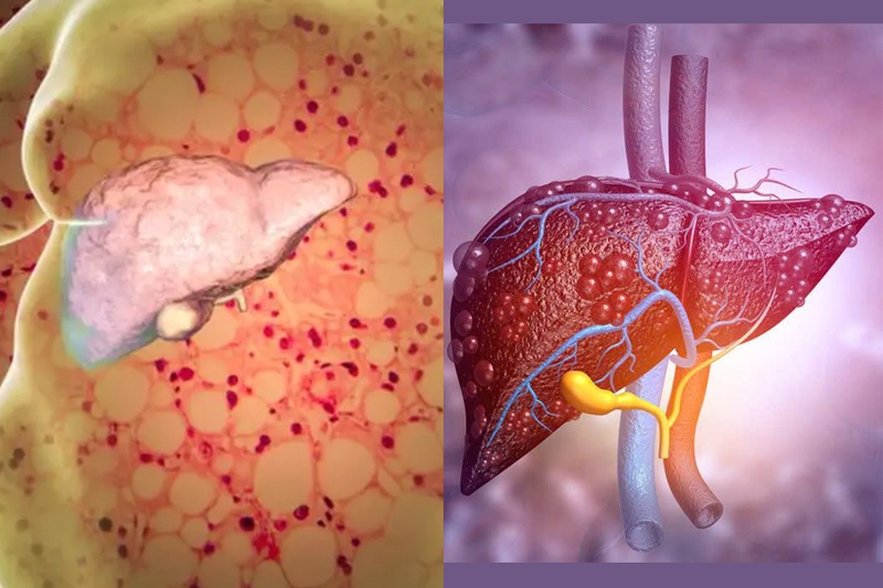 Ai dễ bị bệnh gan nhiễm mỡ? Cách phòng ngừa gan nhiễm mỡ hiệu quả 1