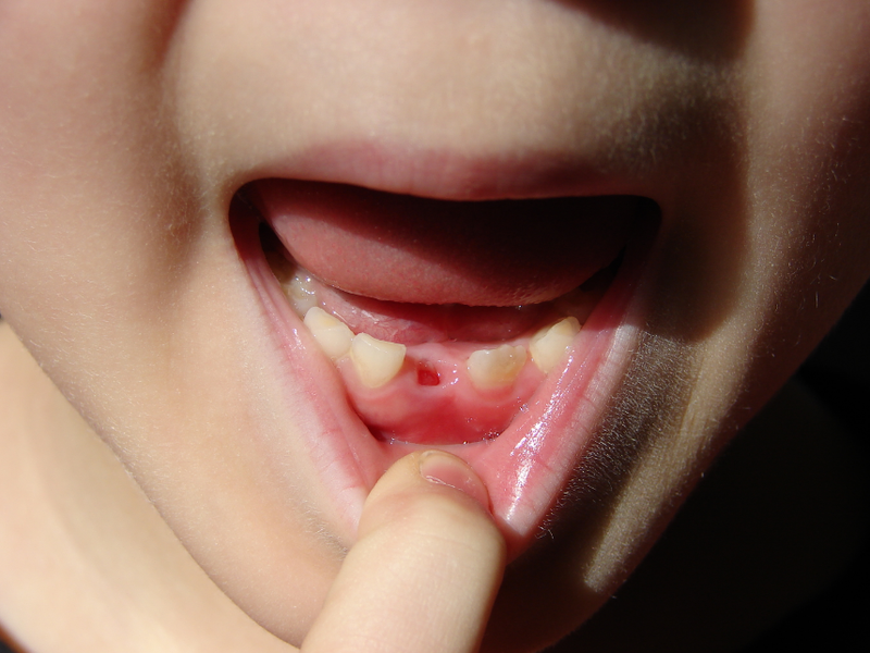 Bé 5 tuổi thay răng sữa có sớm không? Hướng dẫn chăm sóc răng sữa đúng cách cho trẻ  2