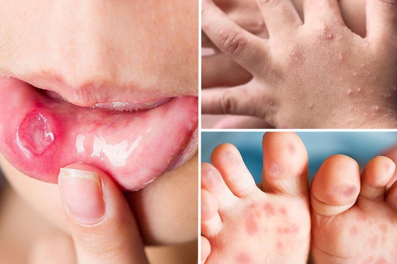 Bé bị tay chân miệng lần 2 có nhẹ hơn lần 1? Cách điều trị và chăm sóc trẻ hiệu quả, an toàn 1
