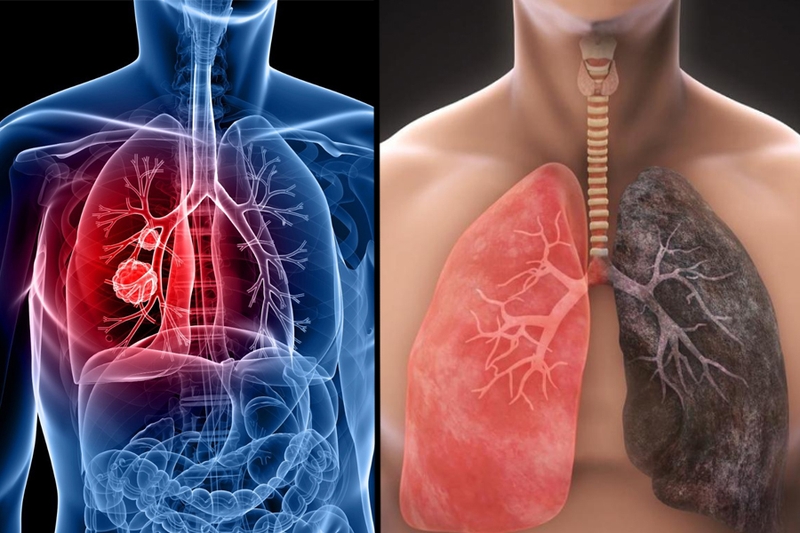 Bệnh ung thư phổi sống được bao lâu? Giai đoạn cuối có chữa được không? 1